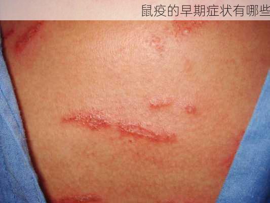 鼠疫的早期症状有哪些