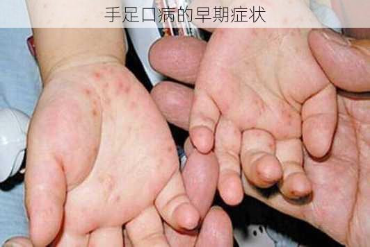 手足口病的早期症状