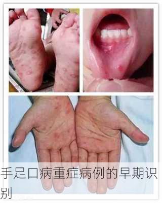 手足口病重症病例的早期识别