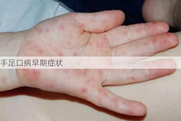 手足口病早期症状
