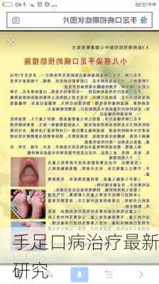 手足口病治疗最新研究