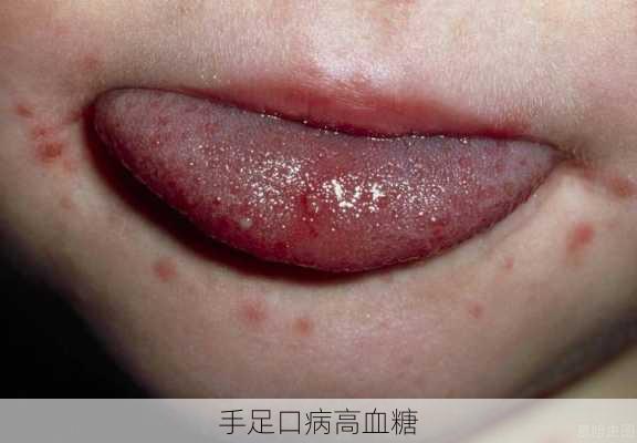 手足口病高血糖