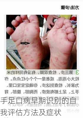 手足口病早期识别的自我评估方法及症状