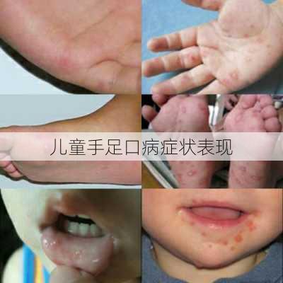 儿童手足口病症状表现