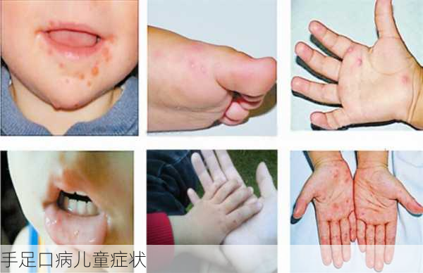 手足口病儿童症状