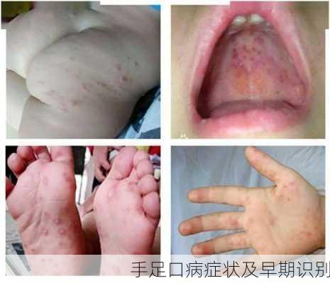 手足口病症状及早期识别