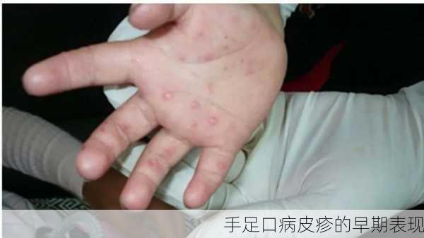 手足口病皮疹的早期表现