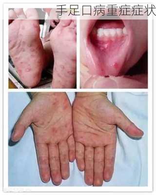 手足口病重症症状