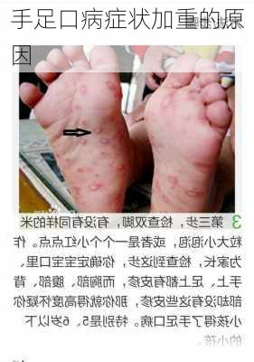手足口病症状加重的原因
