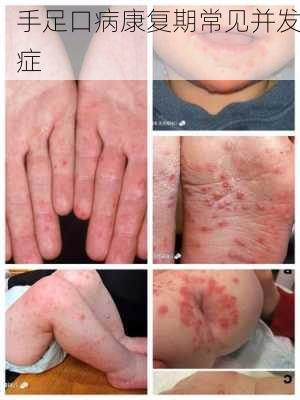 手足口病康复期常见并发症