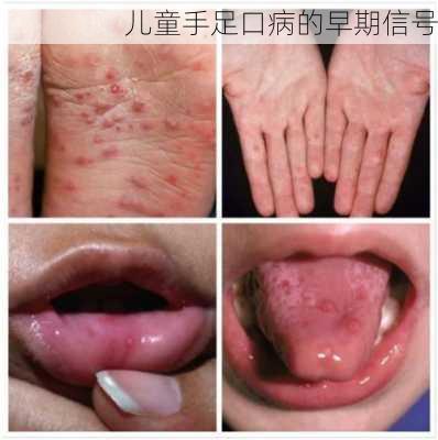 儿童手足口病的早期信号