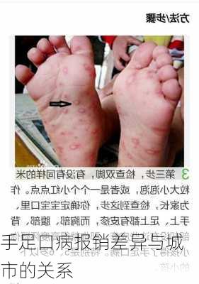 手足口病报销差异与城市的关系