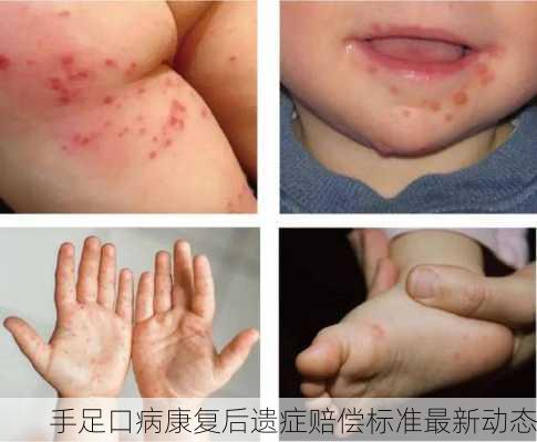 手足口病康复后遗症赔偿标准最新动态