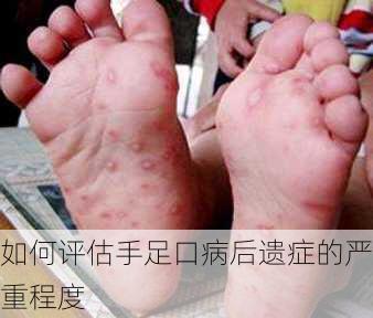如何评估手足口病后遗症的严重程度