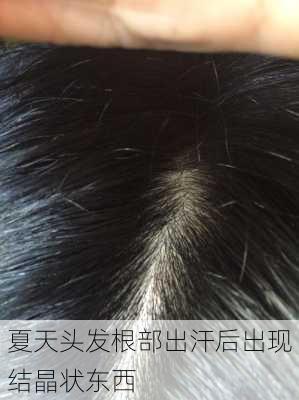 夏天头发根部出汗后出现结晶状东西