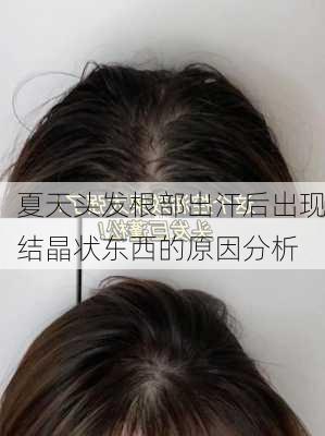 夏天头发根部出汗后出现结晶状东西的原因分析