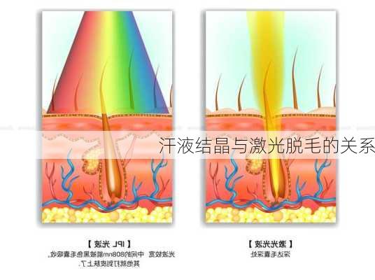 汗液结晶与激光脱毛的关系