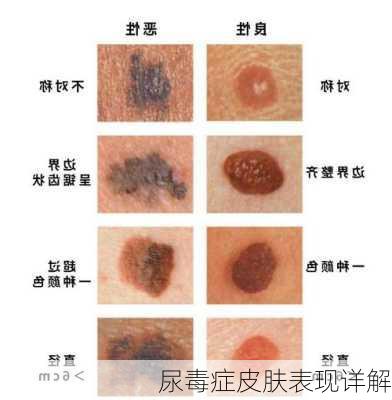 尿毒症皮肤表现详解