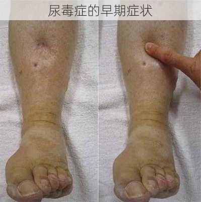 尿毒症的早期症状