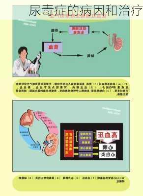 尿毒症的病因和治疗