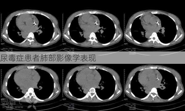 尿毒症患者肺部影像学表现