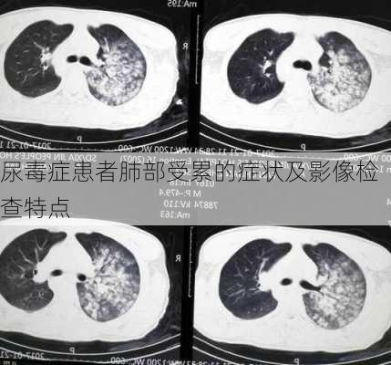 尿毒症患者肺部受累的症状及影像检查特点