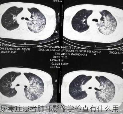 尿毒症患者肺部影像学检查有什么用