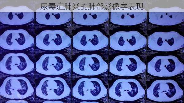 尿毒症肺炎的肺部影像学表现