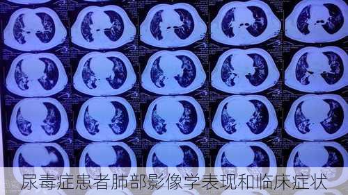 尿毒症患者肺部影像学表现和临床症状