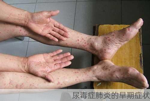 尿毒症肺炎的早期症状