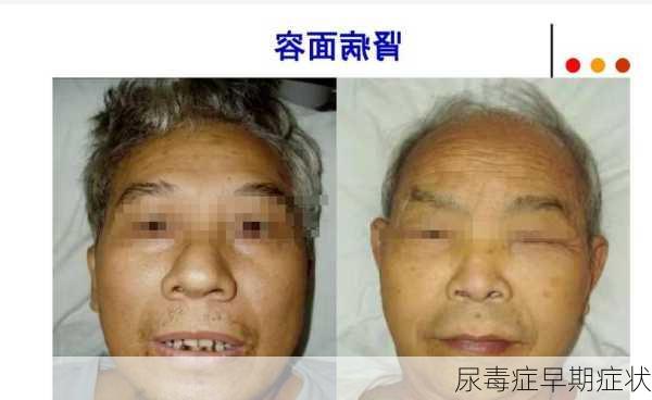 尿毒症早期症状