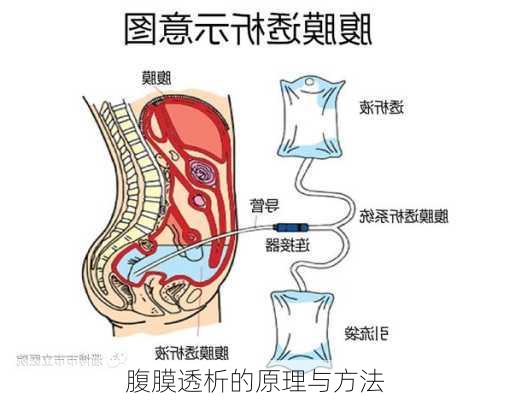 腹膜透析的原理与方法