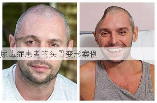 尿毒症患者的头骨变形案例