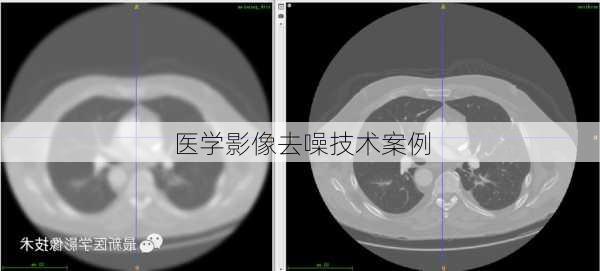 医学影像去噪技术案例