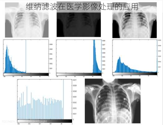 维纳滤波在医学影像处理的应用