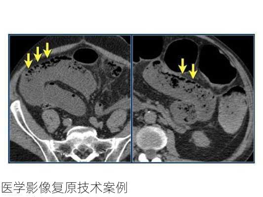 医学影像复原技术案例