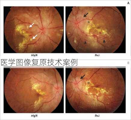 医学图像复原技术案例