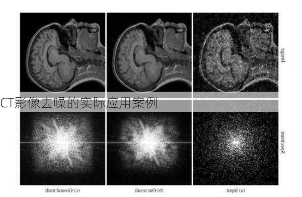 CT影像去噪的实际应用案例