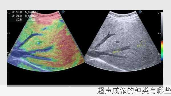 超声成像的种类有哪些