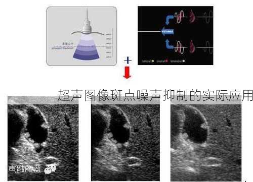 超声图像斑点噪声抑制的实际应用