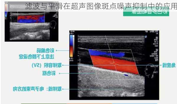 滤波与平滑在超声图像斑点噪声抑制中的应用
