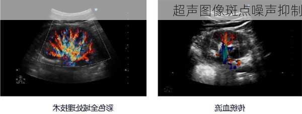 超声图像斑点噪声抑制