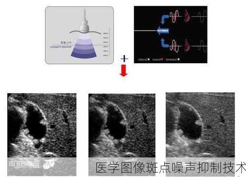 医学图像斑点噪声抑制技术