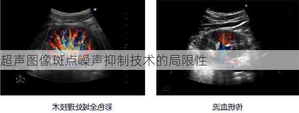 超声图像斑点噪声抑制技术的局限性