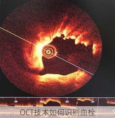 OCT技术如何识别血栓