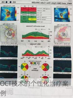 OCT技术的个性化治疗案例