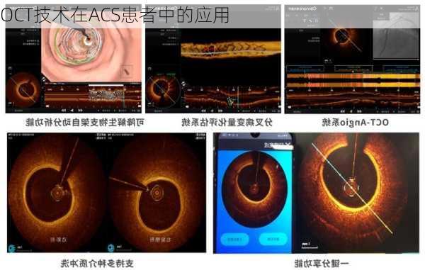 OCT技术在ACS患者中的应用