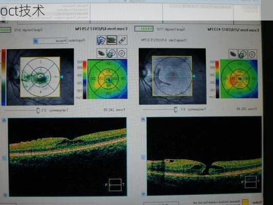oct技术