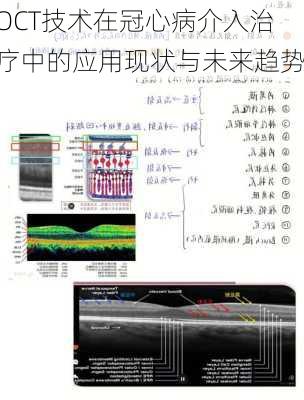 OCT技术在冠心病介入治疗中的应用现状与未来趋势