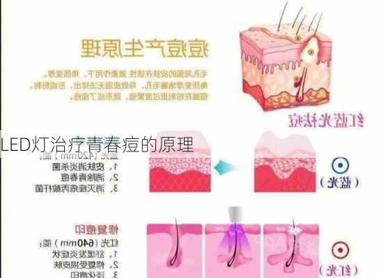 LED灯治疗青春痘的原理